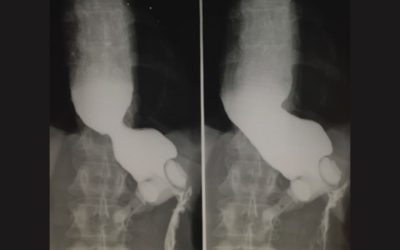 Transit oesophagien ou oeso gastro duodénal (TOGD)